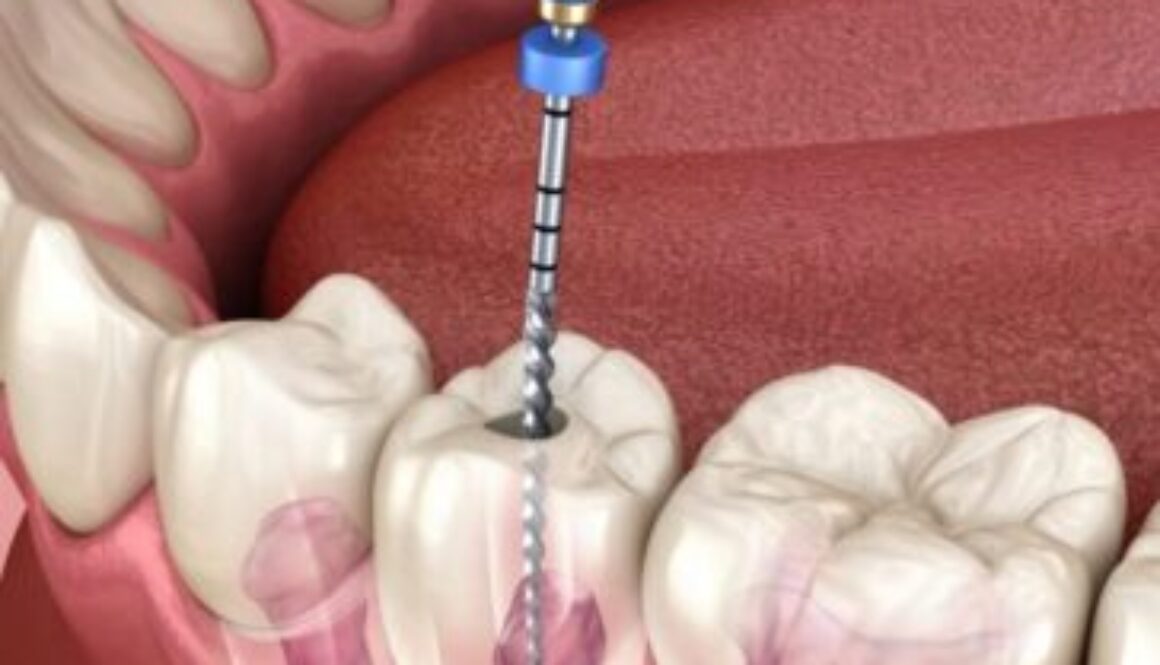 Root-Canal-Treatment-1440x720-1-1024x512-364x234